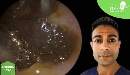 1,248 - DIY Ear Wax Removal Gone Wrong!